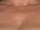 Neck Lifting Treatment, Bust Lifting Treatment