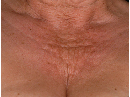 Neck Lifting Treatment, Bust Lifting Treatment